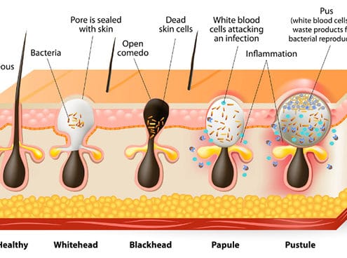 Différents stades d’acné vulgaris