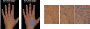 Acquisition d’image du dos de la main avec le DigiCam ® et analyse des taches de pigmentation