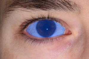 Acquisition d’image de l’œil avec l’EyelashCam® et mesure angulaire et surfacique de l’oeil 