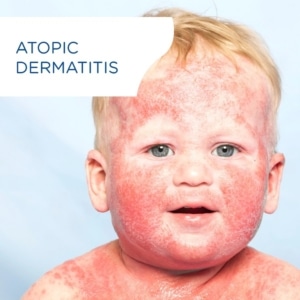 Encart Zoom - Models for Atopic Dermatitis Research and Efficacy Testing
