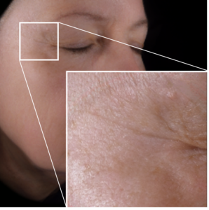 Wrinkle_After