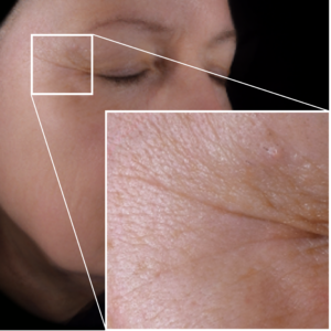 Wrinkle_Before