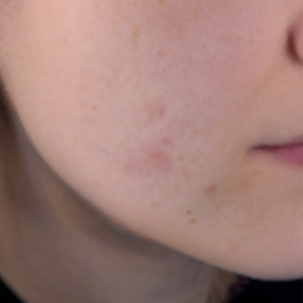 Woman face with Oily skin before skicare routine