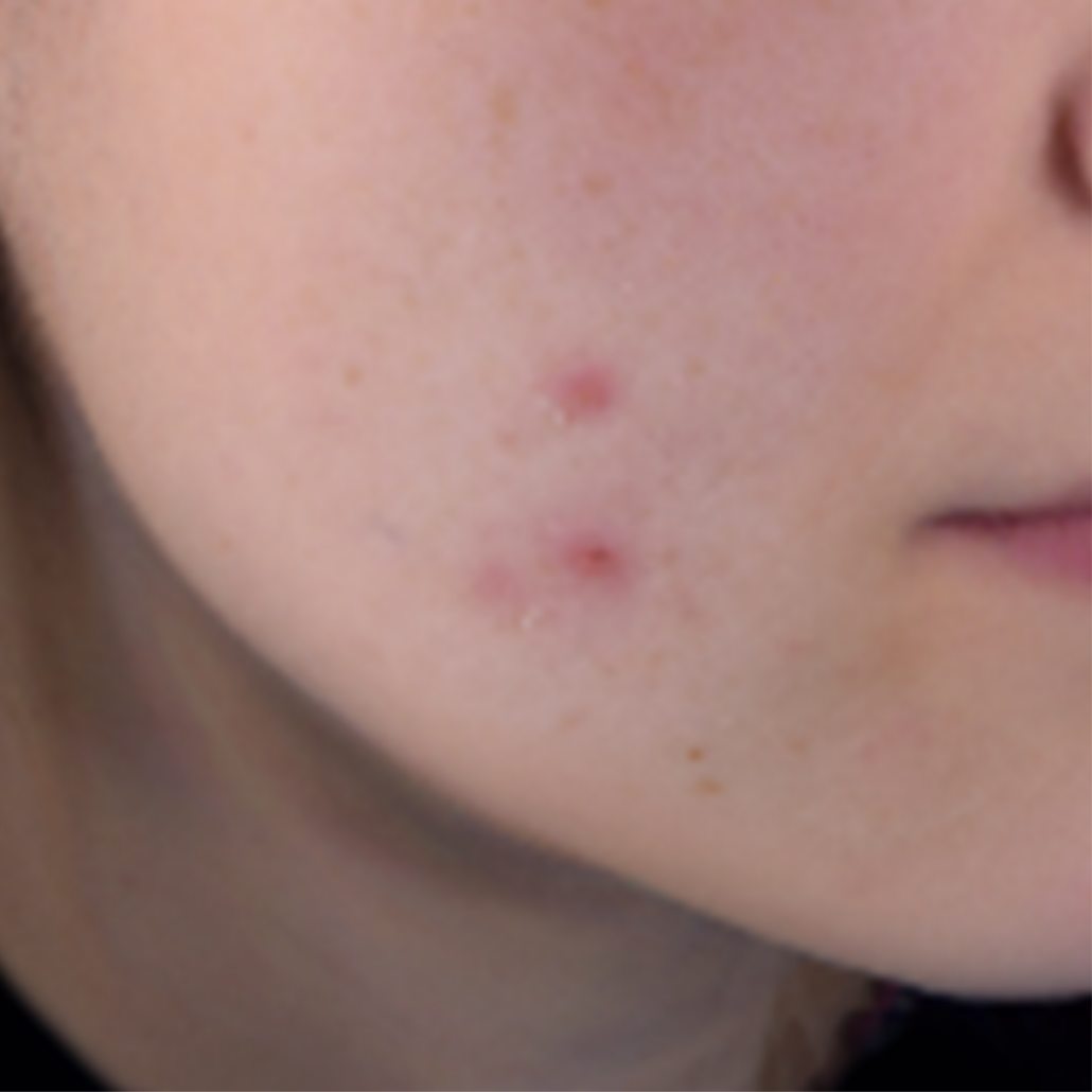 Woman face with Oily skin before skicare routine