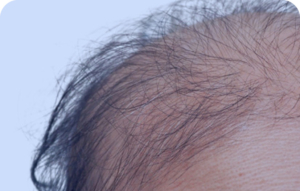 Chemotherapy Induced Alopecia Button, Rounded Top Corners