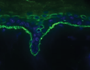 Pemphigoid disease_Complement fixation assay_IgG3 autoantibody