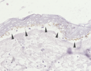 Pemphigoid disease_Crysection assay_split formation_positive control-autoantibody