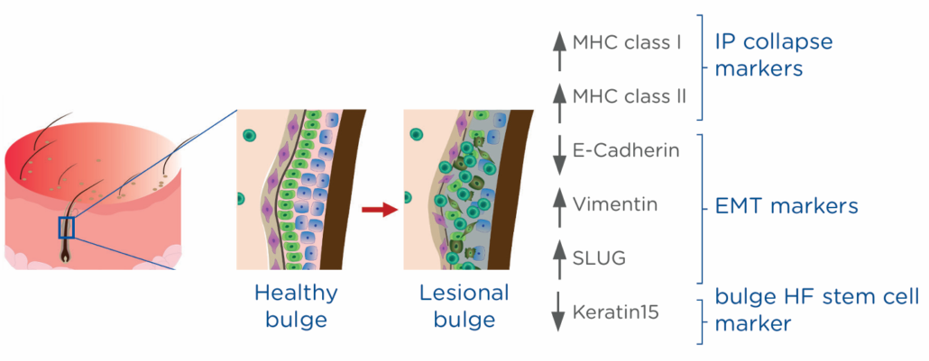 Scarring alopecia_scheme