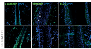 Scarring alopecia - PPAR-γ - immuno pics PPAR-γ stimulation by N-Acetyl-GED reverses the established epithelial-to-mesenchymal transition in the bulge of lesional LPP HFs ex vivo